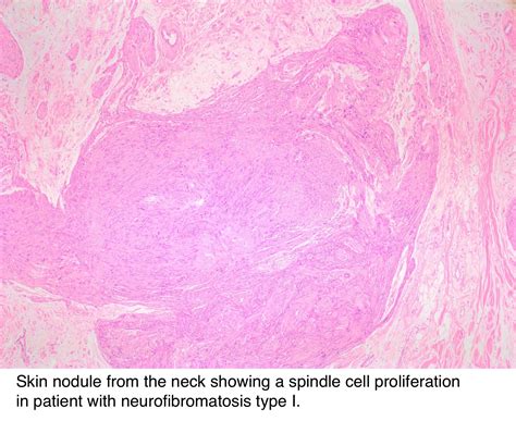 Pathology Outlines - Neurofibroma-general