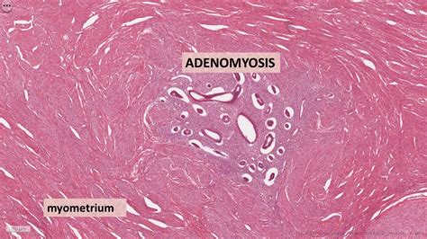 Pathology of Adenomyosis | Pathology Made Simple