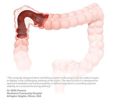 Evolution® Controlled-Release Stent | Endoscopy