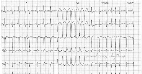 ECG Rhythms: MAT with NSVT