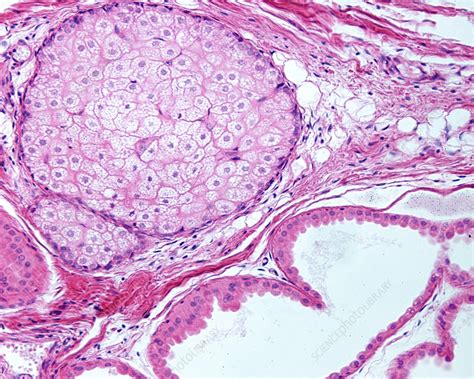 Sebaceous gland and apocrine sweat gland, light micrograph - Stock ...