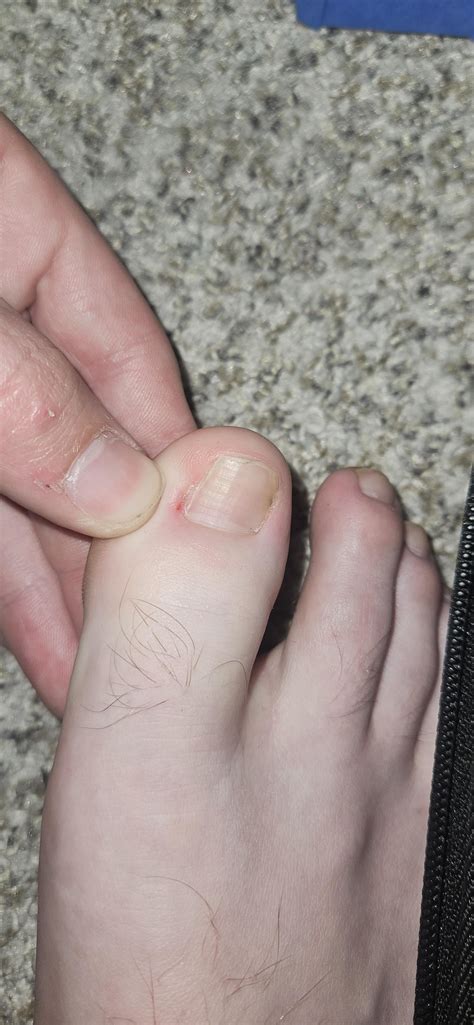 Is this normal one year after phenol matrixectomy? : r/Ingrown_Toenails