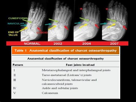 Charcot foot