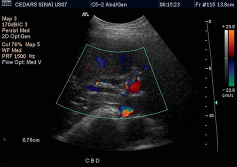 Abdominal Ultrasound | Cedars-Sinai