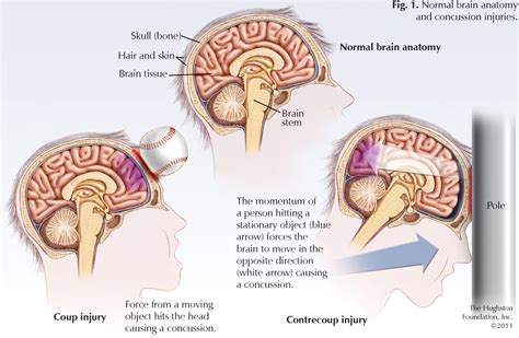 Concussions in Sports - Hughston Clinic