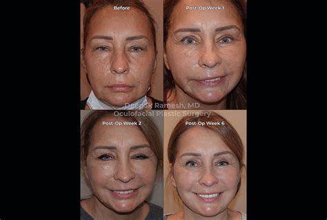 Recovery from Face/Neck Lift New Jersey | Center for Eye & Facial Plastics