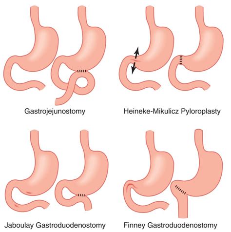 Vagotomy And Pyloroplasty