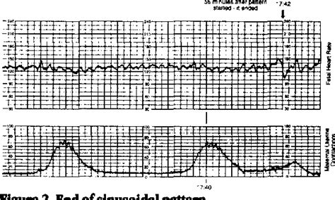 Figure 2 from Sinusoidal Fetal Heart Rate Pattern After Administration ...