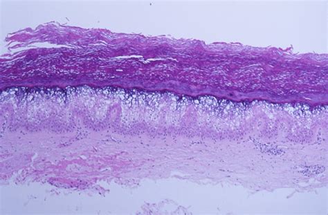 Pathology Outlines - Epidermolytic hyperkeratosis