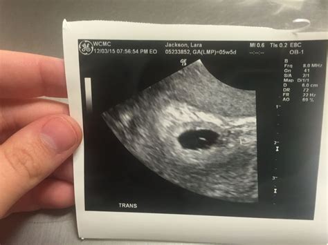 5 weeks 5 days pregnant. Baby's first Sonogram! ️ 3 Weeks Pregnant ...