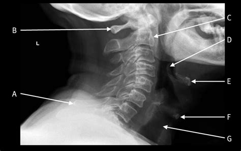 Base and body cervical spine x ray - findersrolf