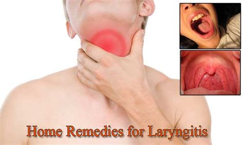 25 Home Remedies for Laryngitis - Home Remedies - Natural & Herbal ...