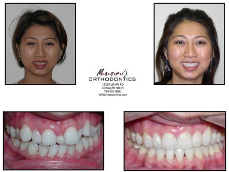 Open Bite Jaw Surgery & Braces Before and After Treatment