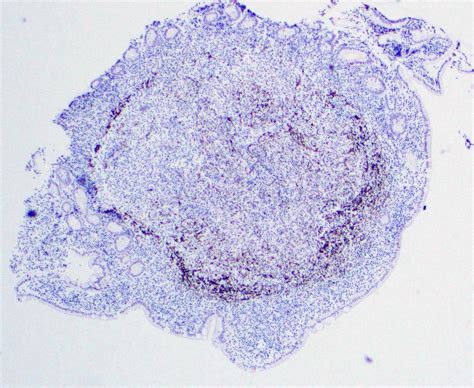 Pathology Outlines - Follicular lymphoma-duodenal type