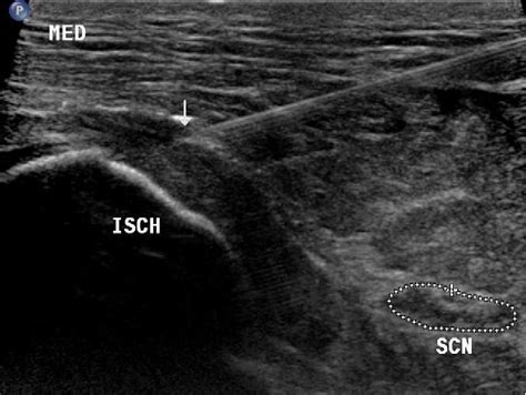 Figure 2 from Ultrasound-guided ischial bursa injection: technique and positioning ...