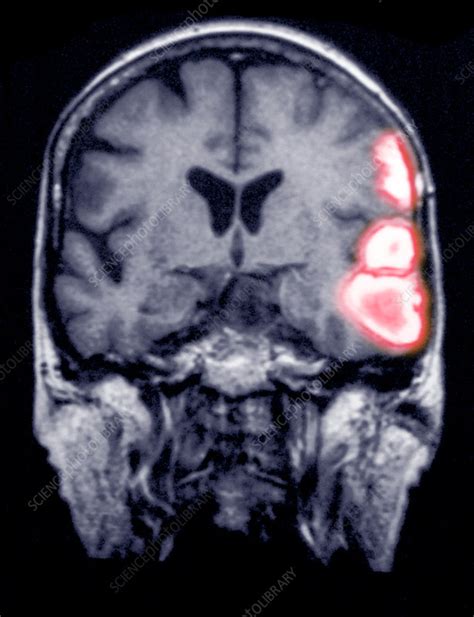 Temporoparietal brain haemorrhage, MRI - Stock Image - C030/5850 ...