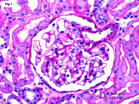 Thin Basement Membrane Disease (TBMD) | Teaching Points