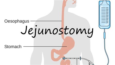 How to Pronounce Jejunostomy? - YouTube