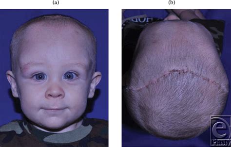 Craniosynostosis