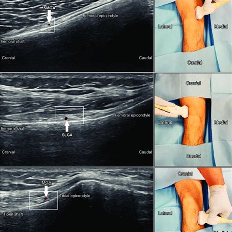 (PDF) Comparison of the efficacy of genicular nerve phenol neurolysis ...