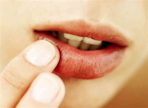 👉 Sunburned Lips - Pictures, Symptoms, Treatment, Causes (December 2021)