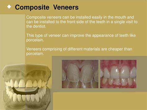 PPT - Dental Veneers PowerPoint Presentation, free download - ID:7352653