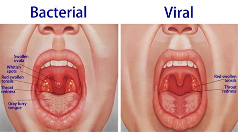 Tonsillitis: Causes, Symptoms, Treatment & Home Remedies » How To Relief