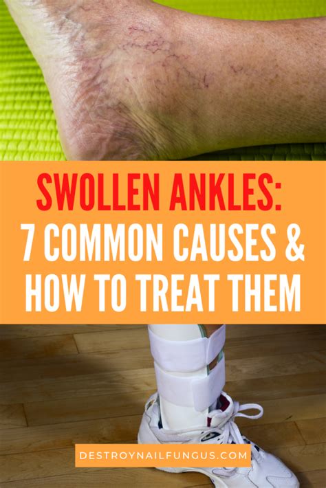 How To Treat Swollen Ankles: 7 Best Treatment Options