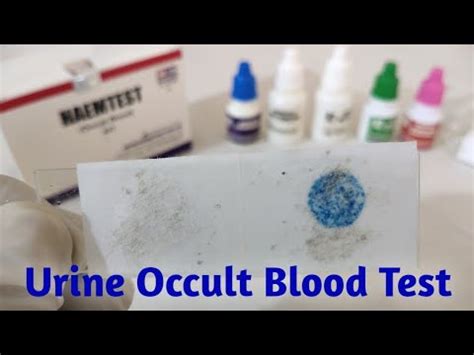 What is occult blood in urine || occult blood positive means ...