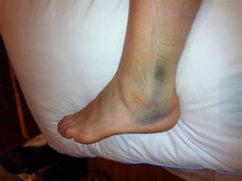 Entry 2: The Rainbow Bruised Goddess – Hugo Mobility