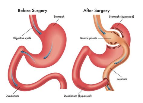 Roux-en-Y Gastric Bypass (RYGB) surgery - The Endocrine Doc