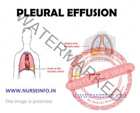 PLEURAL EFFUSION - Nurse Info