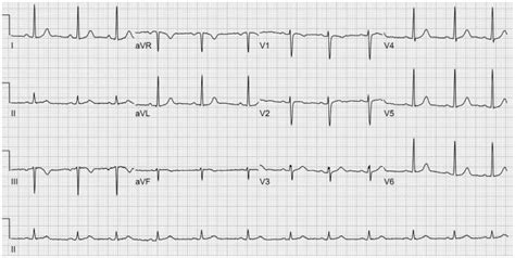 Electrocardiogram showing non specific T wave inversion in lead lll ...