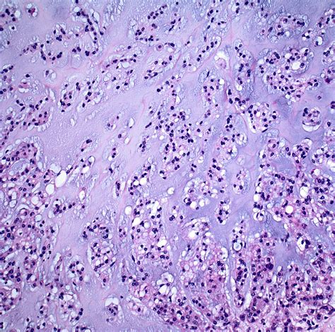 Pathology Outlines - Chordoma