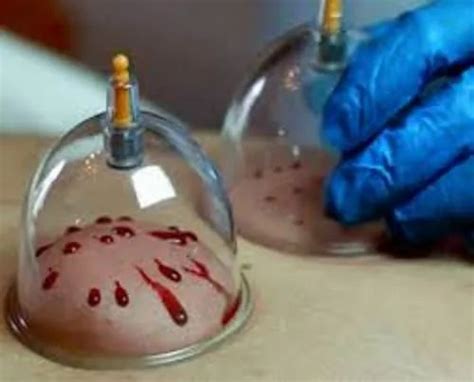 Diploma in Hijama Cupping Therapy (D.H.Cup.) at Rs 4500/course in Jodhpur | ID: 21105992355