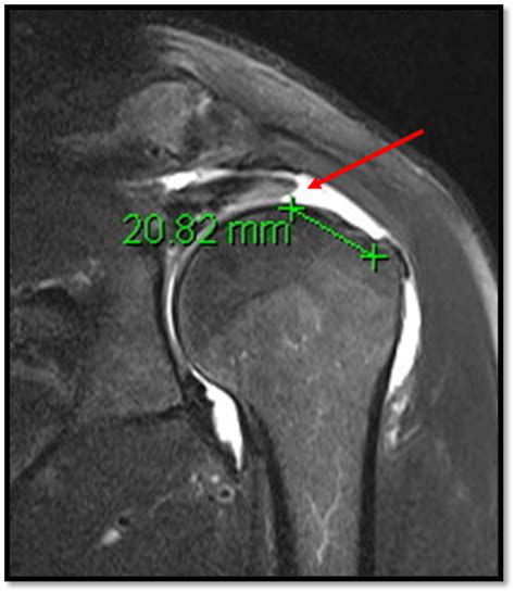 Rotator Cuff Tear Treatment | Singapore Arthroscopic Surgeon