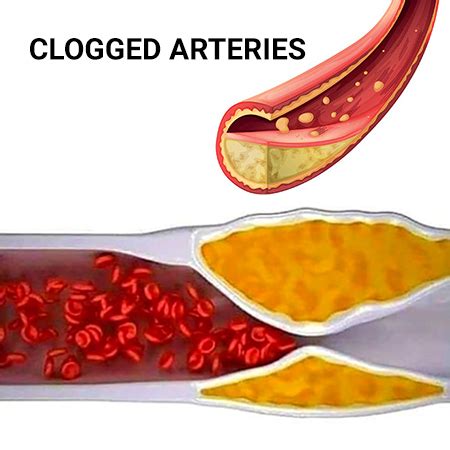 Clogged Arteries: What Causes Them and Why They Are Dangerous? - New ...