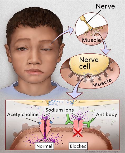 Myasthenia Gravis | Children's Hospital of Philadelphia