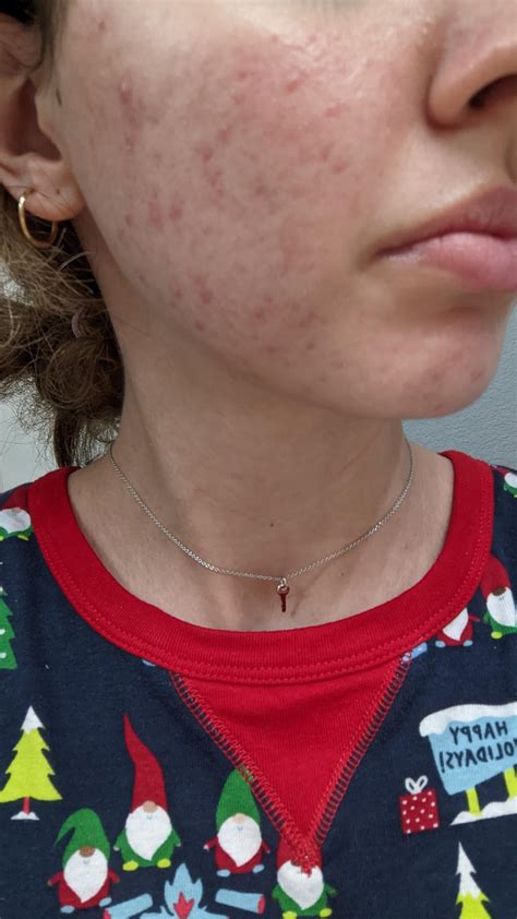 [acne] 1.5 months on generic yaz bc for PCOS acne : r/SkincareAddiction