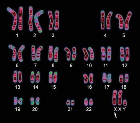 Klinefelter syndrome | Definition, Symptoms, Treatment, & Life Expectancy | Britannica.com