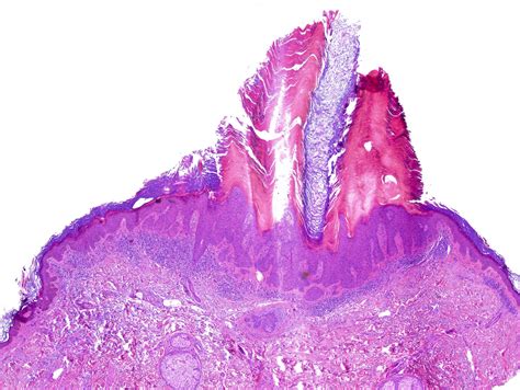 Hypertrophic Actinic Keratosis Histology