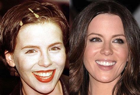 Kate Beckinsale: Plastic Surgery Done Right