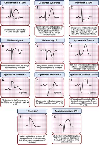 Electrocardiographic Diagnosis of Life-Threatening STEMI Equivalents: When Every Minute Counts∗ ...