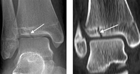 IMAGING GUIDED EUFLEXXA INJECTION FOR MANAGEMENT OF KNEE OSTEOARTHRITIS ...