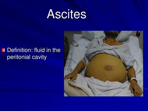 Cirrhosis as related to Ascites - Pictures