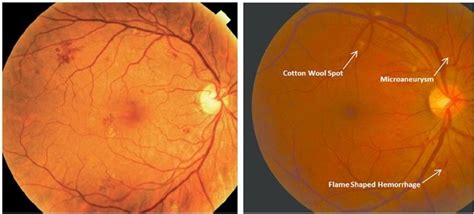 Retinal image with some DR features: Mild-non-proliferative diabetic... | Download Scientific ...