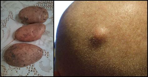 It’s everyone’s nightmare: you wake up one morning with a huge, gross, painful bump. What is it ...