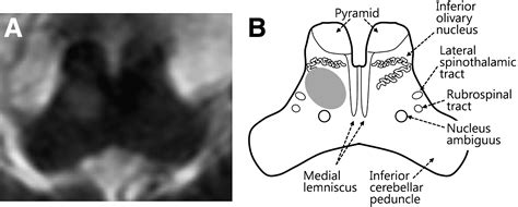 Truncal Ataxia From Infarction Involving the Inferior Olivary Nucleus ...