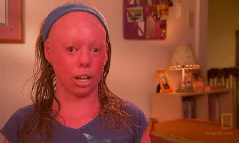 Harlequin Ichthyosis - Pictures, Survivor, Symptoms, Causes, Treatment