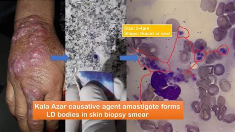 Kala Azar causative agent amastigote forms LD bodies in skin biopsy smear - YouTube